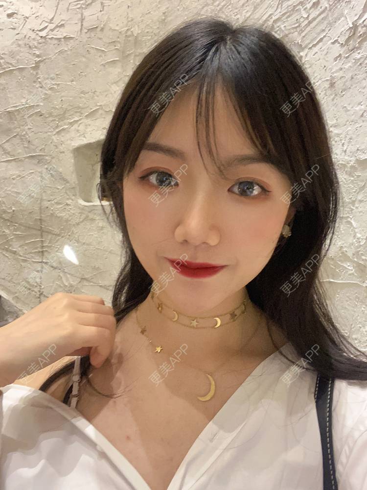 更美 - 镜子里你哭了.展的全切双眼皮经验 | 全切双眼皮 | 成都 | 眶隔脂肪释放 | 眼部多项