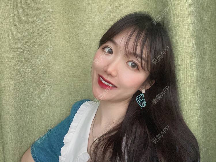 更美 - 镜子里你哭了.展的全切双眼皮经验 | 全切双眼皮 | 成都 | 眶隔脂肪释放 | 眼部多项