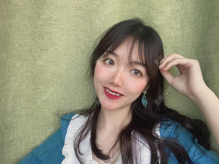 更美 - 镜子里你哭了.展的全切双眼皮经验 | 全切双眼皮 | 成都 | 眶隔脂肪释放 | 眼部多项