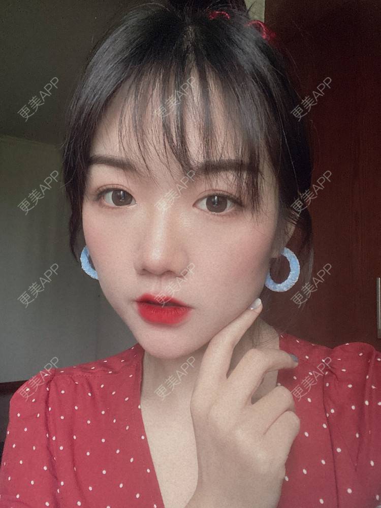 更美 - 镜子里你哭了.展的全切双眼皮经验 | 全切双眼皮 | 成都 | 眶隔脂肪释放 | 眼部多项