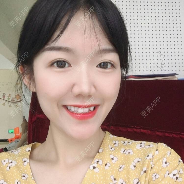 更美 - 镜子里你哭了.展的全切双眼皮经验 | 全切双眼皮 | 成都 | 眶隔脂肪释放 | 眼部多项