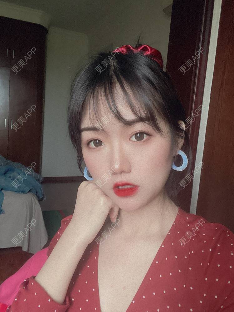 更美 - 镜子里你哭了.展的全切双眼皮经验 | 全切双眼皮 | 成都 | 眶隔脂肪释放 | 眼部多项