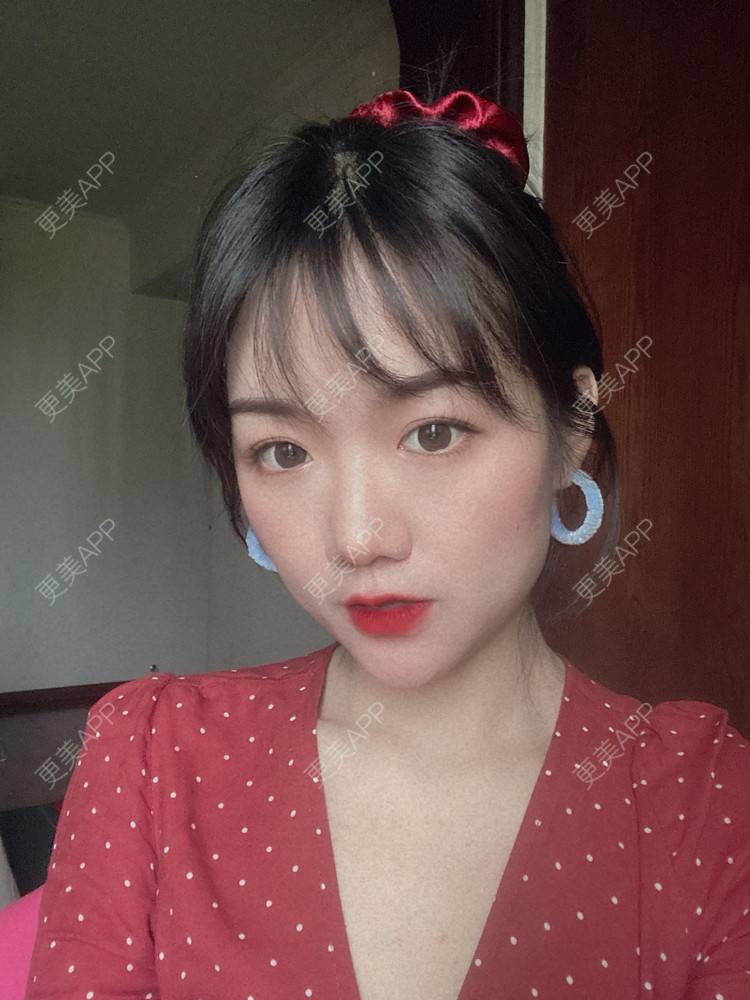 更美 - 镜子里你哭了.展的全切双眼皮经验 | 全切双眼皮 | 成都 | 眶隔脂肪释放 | 眼部多项