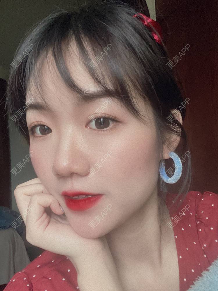 更美 - 镜子里你哭了.展的全切双眼皮经验 | 全切双眼皮 | 成都 | 眶隔脂肪释放 | 眼部多项