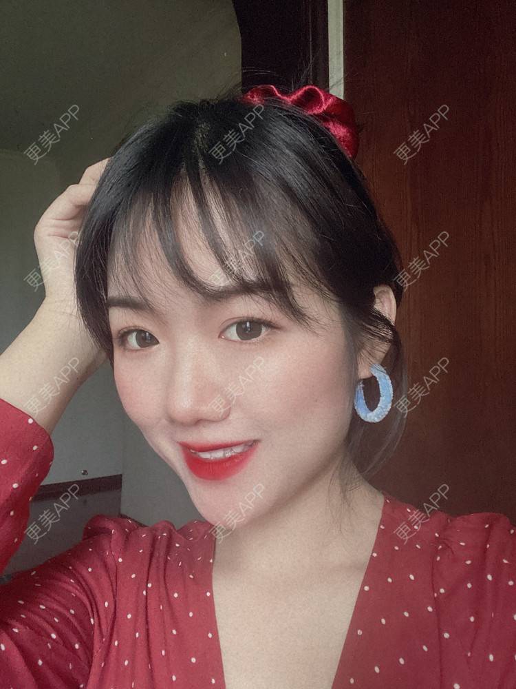 更美 - 镜子里你哭了.展的全切双眼皮经验 | 全切双眼皮 | 成都 | 眶隔脂肪释放 | 眼部多项