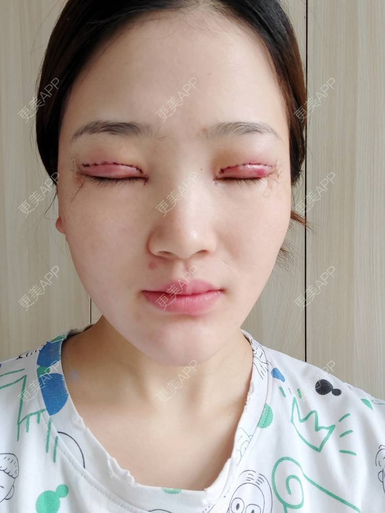 一个感叹号的全切双眼皮日记