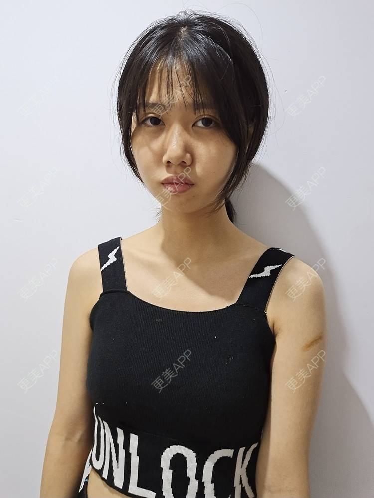 更美 - 更美用户ybyHVPzzuD的激光淡疤经验 | 综合淡疤 | 皮肤美容 | 激光淡疤 | 成都