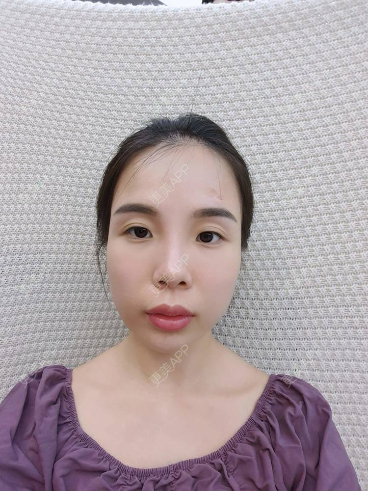 更美 - 嘟嘴小妹俏的经验 | 手术淡疤 | 综合淡疤 | 激光淡疤 | 成都