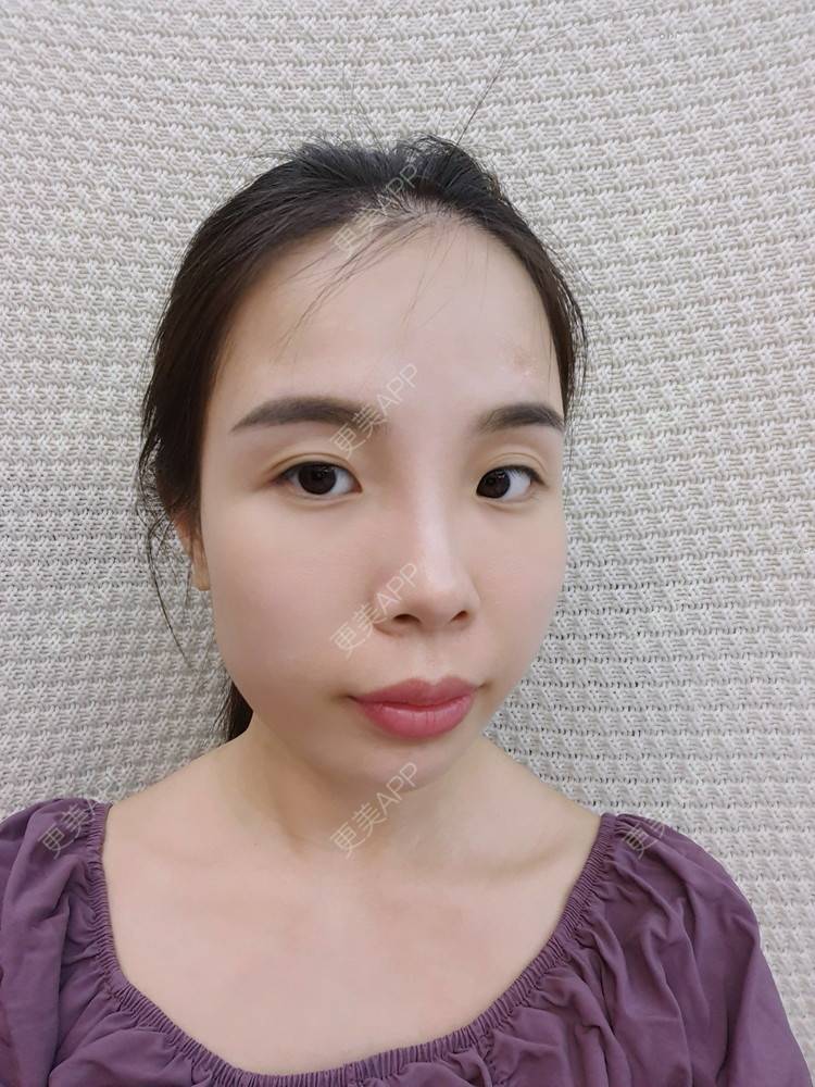 更美 - 嘟嘴小妹俏的经验 | 手术淡疤 | 综合淡疤 | 激光淡疤 | 成都