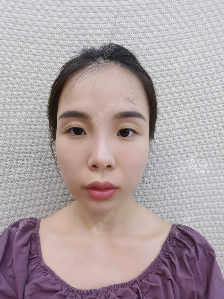 更美 - 嘟嘴小妹俏的经验 | 手术淡疤 | 综合淡疤 | 激光淡疤 | 成都