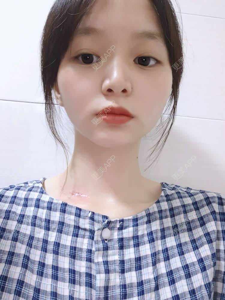 更美 - 维多利亚月光泛的激光淡疤经验 | 综合淡疤 | 皮肤美容 | 激光淡疤 | 成都