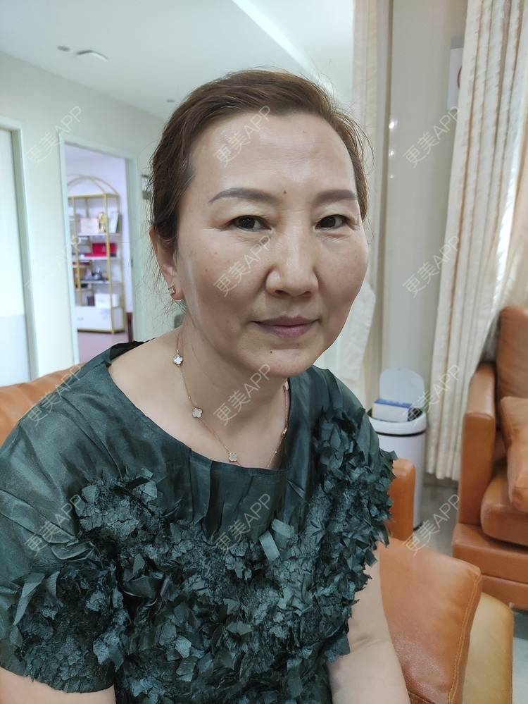 更美 - 更美用户sYQb3nkSfI的胶原蛋白改善面部细纹经验 | 玻尿酸面颊 | 胶原蛋白改善面部细纹 | 深圳