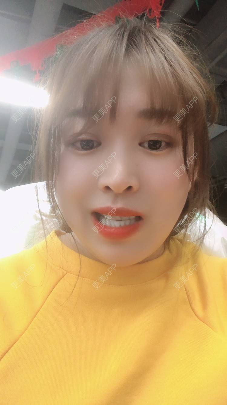 更美 - 更美用户nOSa2OXrxm的冷光美白经验 | 北京 | 冷光美白