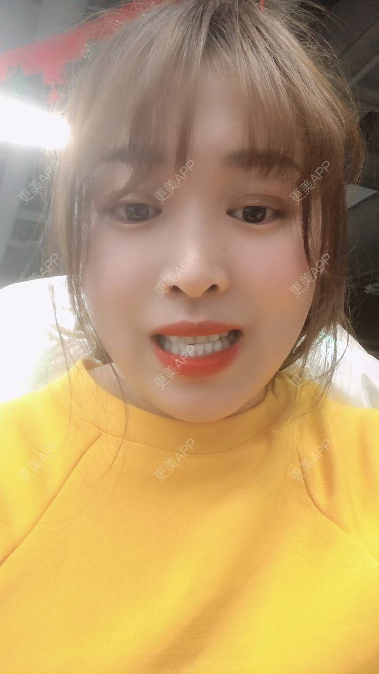 更美 - 更美用户nOSa2OXrxm的冷光美白经验 | 北京 | 冷光美白