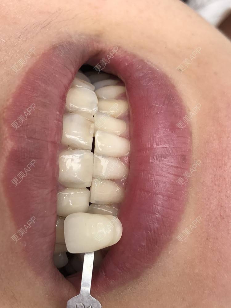 更美 - 更美用户nOSa2OXrxm的冷光美白经验 | 北京 | 冷光美白