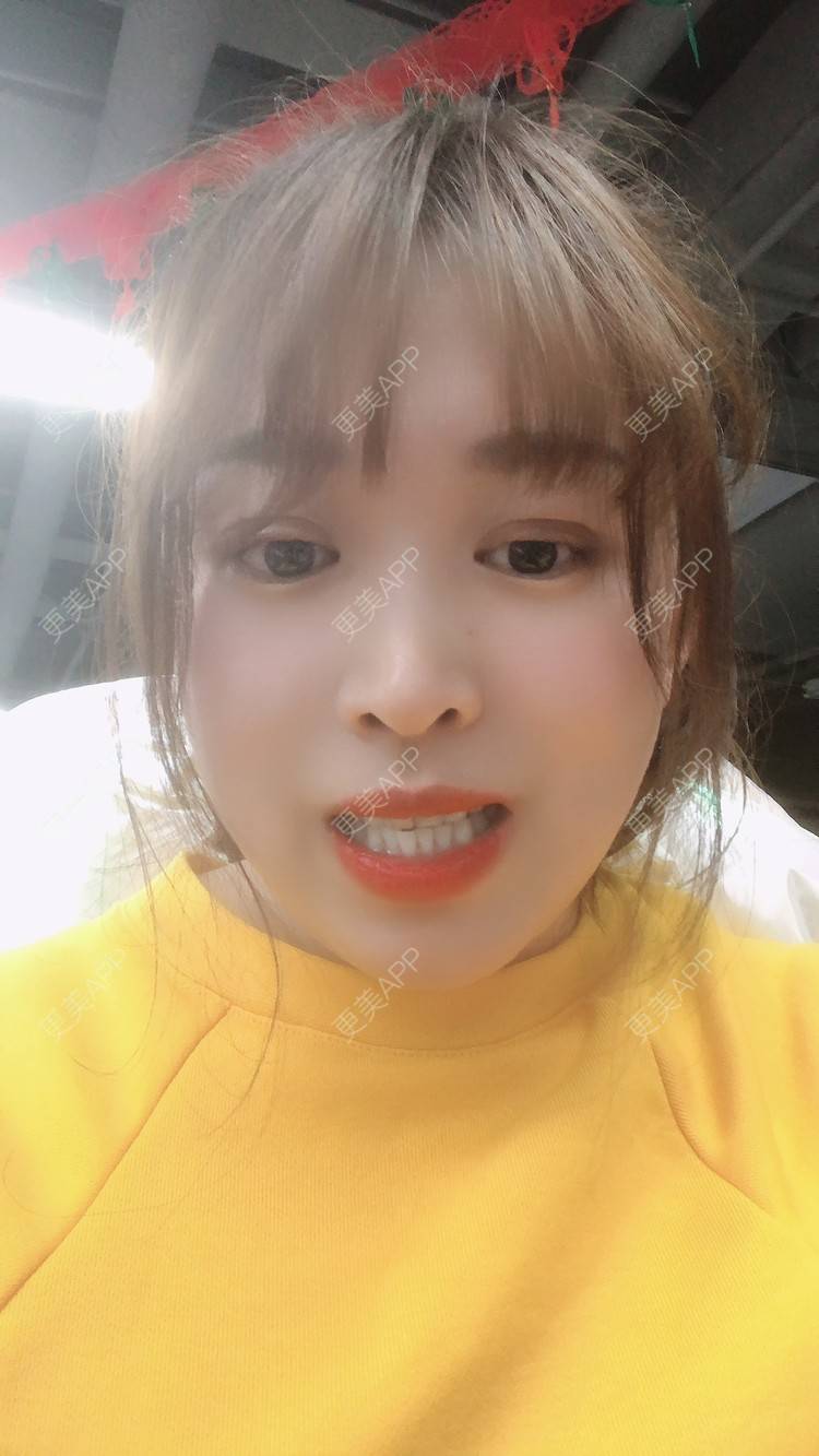 更美 - 更美用户nOSa2OXrxm的冷光美白经验 | 北京 | 冷光美白