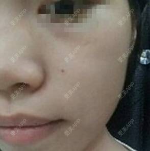 更美 - #＋弥撒少女位的黄金微针经验 | 黄金微针 | 广州