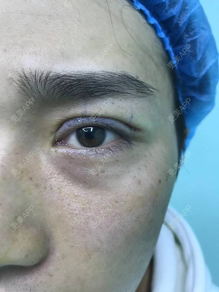 更美 - 更美用户83fI9sL7hW的双眼皮经验 | 双眼皮 | 眼皮下垂矫正 | 眼部多项 | 全切双眼皮 | 半永久妆