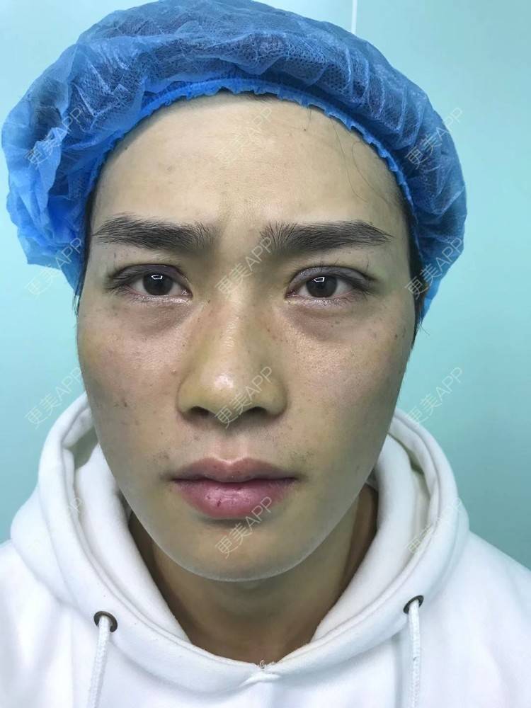 更美 - 更美用户83fI9sL7hW的双眼皮经验 | 双眼皮 | 眼皮下垂矫正 | 眼部多项 | 全切双眼皮 | 半永久妆