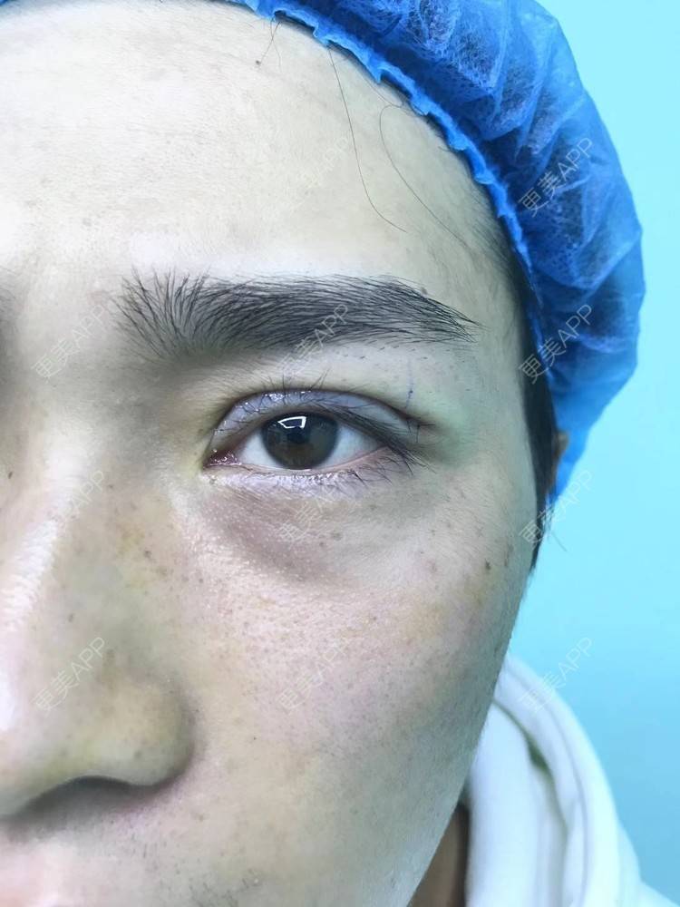 更美 - 更美用户83fI9sL7hW的双眼皮经验 | 双眼皮 | 眼皮下垂矫正 | 眼部多项 | 全切双眼皮 | 半永久妆
