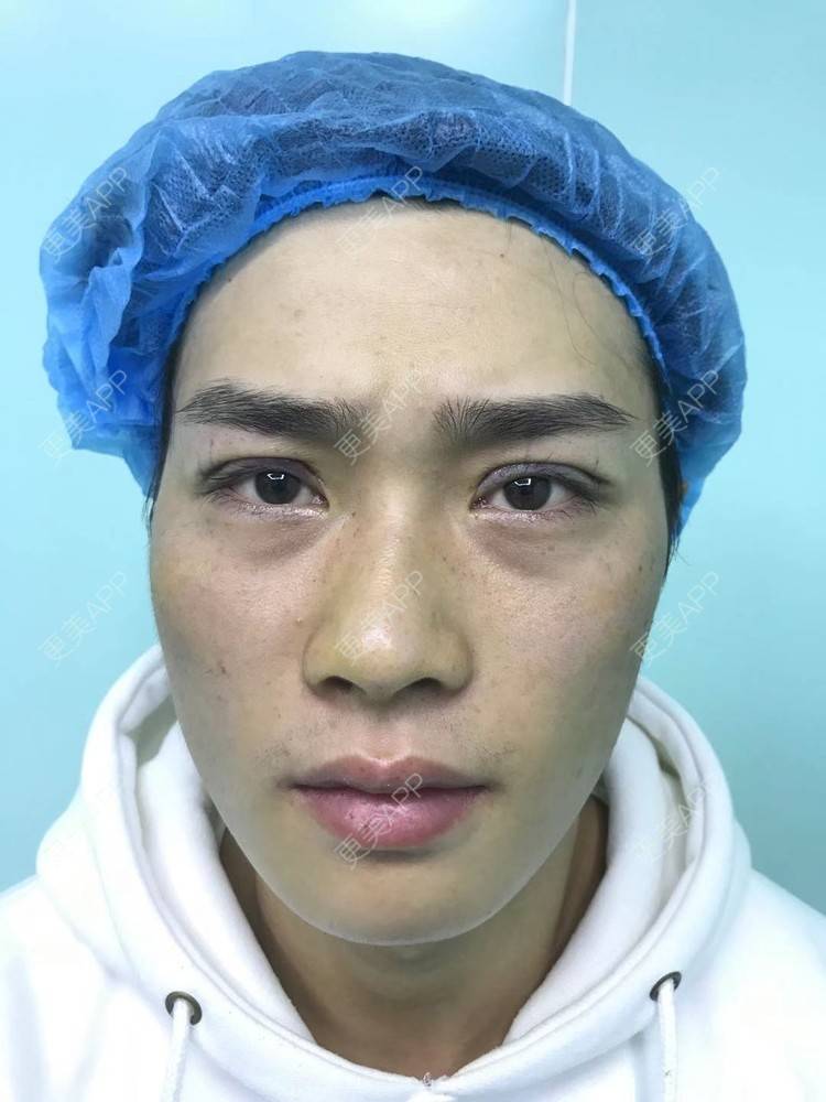 更美 - 更美用户83fI9sL7hW的双眼皮经验 | 双眼皮 | 眼皮下垂矫正 | 眼部多项 | 全切双眼皮 | 半永久妆