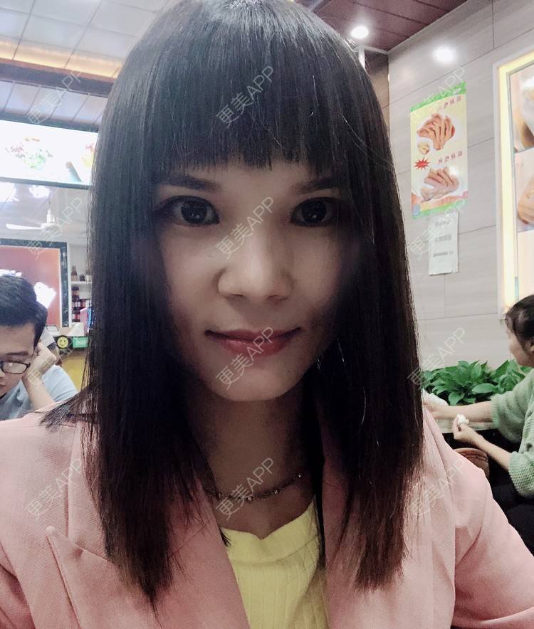 更美 - 更美用户VSU8yakGQY的改善动态纹经验 | 广州 | 改善动态纹 | 改善鱼尾纹
