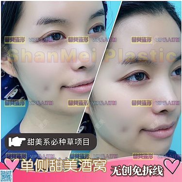 18号 在郑州善美医疗美容门诊部,由曾康院长设计的酒窝,手术时间很快