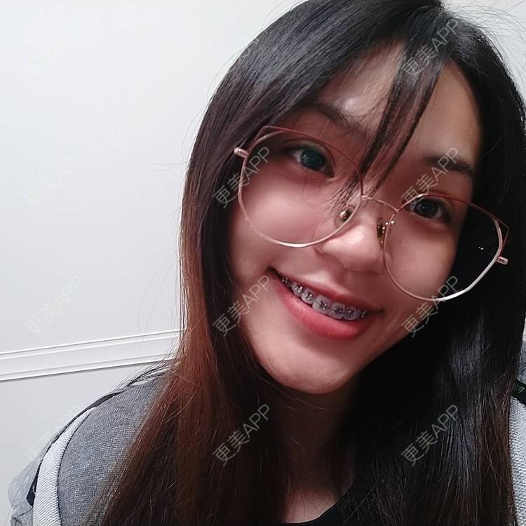 更美 - 更美用户9hRBPWQShy的金属托槽矫正经验 | 佛山 | 金属托槽矫正