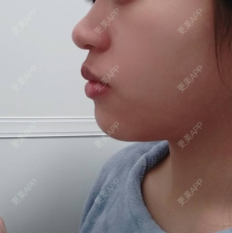 更美 - 更美用户9hRBPWQShy的金属托槽矫正经验 | 佛山 | 金属托槽矫正