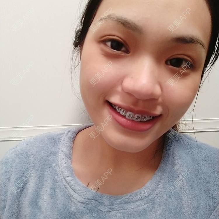 更美 - 更美用户9hRBPWQShy的金属托槽矫正经验 | 佛山 | 金属托槽矫正