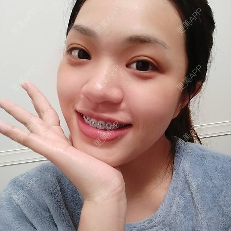 更美 - 更美用户9hRBPWQShy的金属托槽矫正经验 | 佛山 | 金属托槽矫正