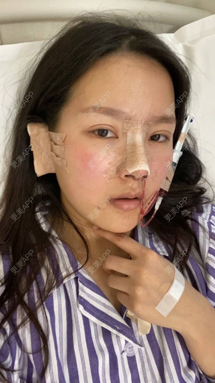 更美 - QHY 💓的鼻部多项经验 | 耳软骨隆鼻 | 鼻翼缩小 | 手术缩鼻头 | 鼻部多项 | 郑州