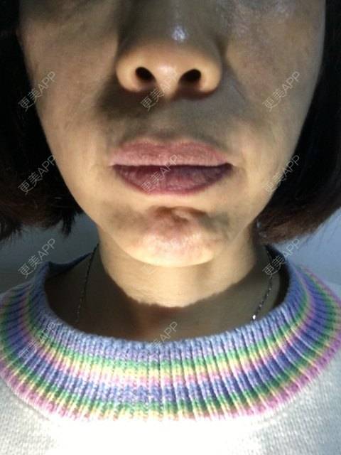更美 - 更美用户X6u7ZrZMyz的膨体垫下巴经验 | 膨体垫下巴