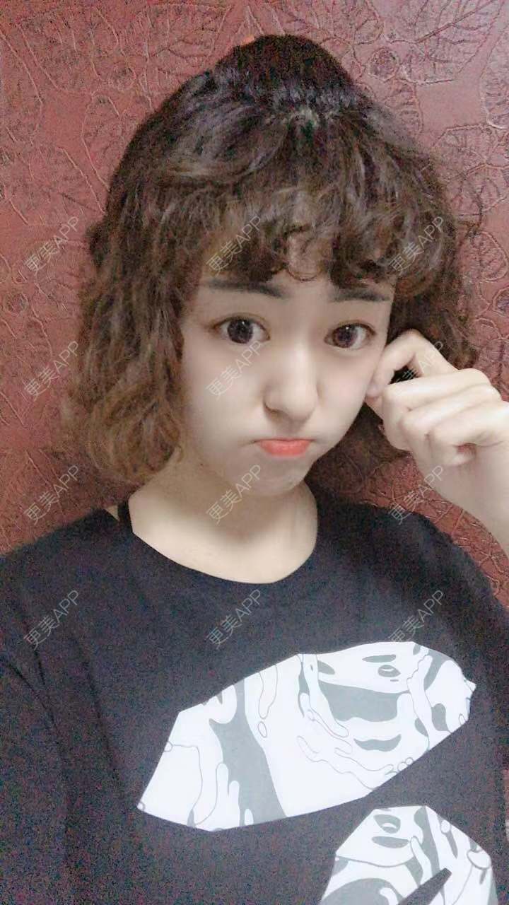 更美 - 更美用户PWR7uLOkkK的玻尿酸下巴经验 | 广州 | 玻尿酸下巴