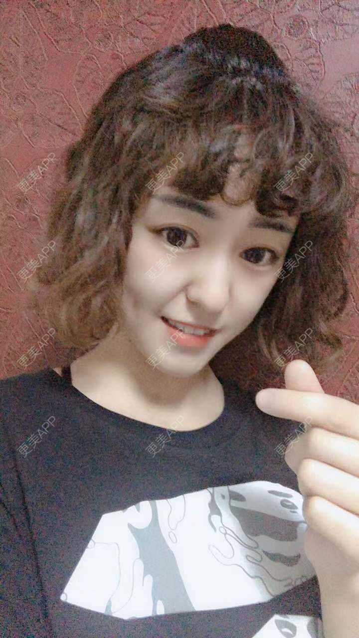 更美 - 更美用户PWR7uLOkkK的玻尿酸下巴经验 | 广州 | 玻尿酸下巴