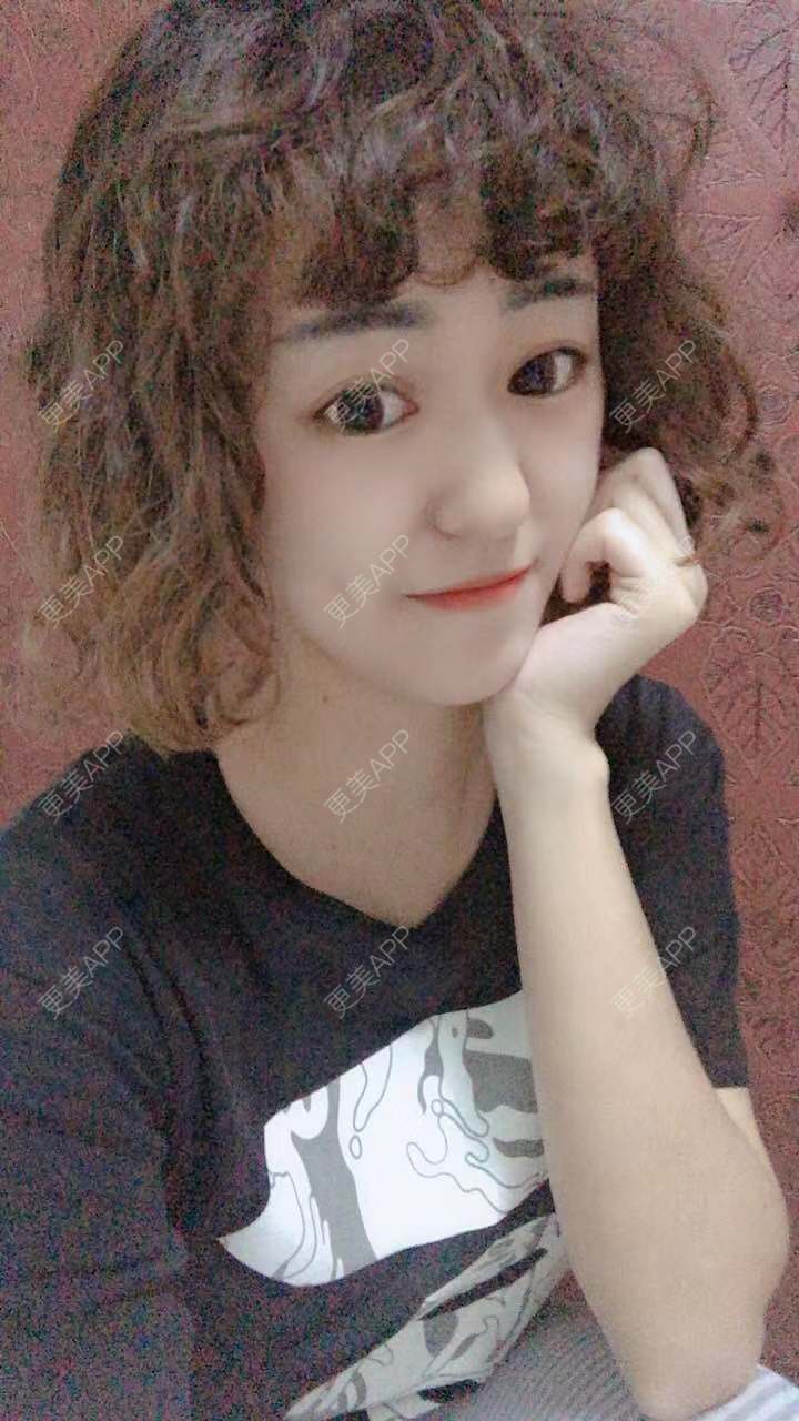 更美 - 更美用户PWR7uLOkkK的玻尿酸下巴经验 | 广州 | 玻尿酸下巴