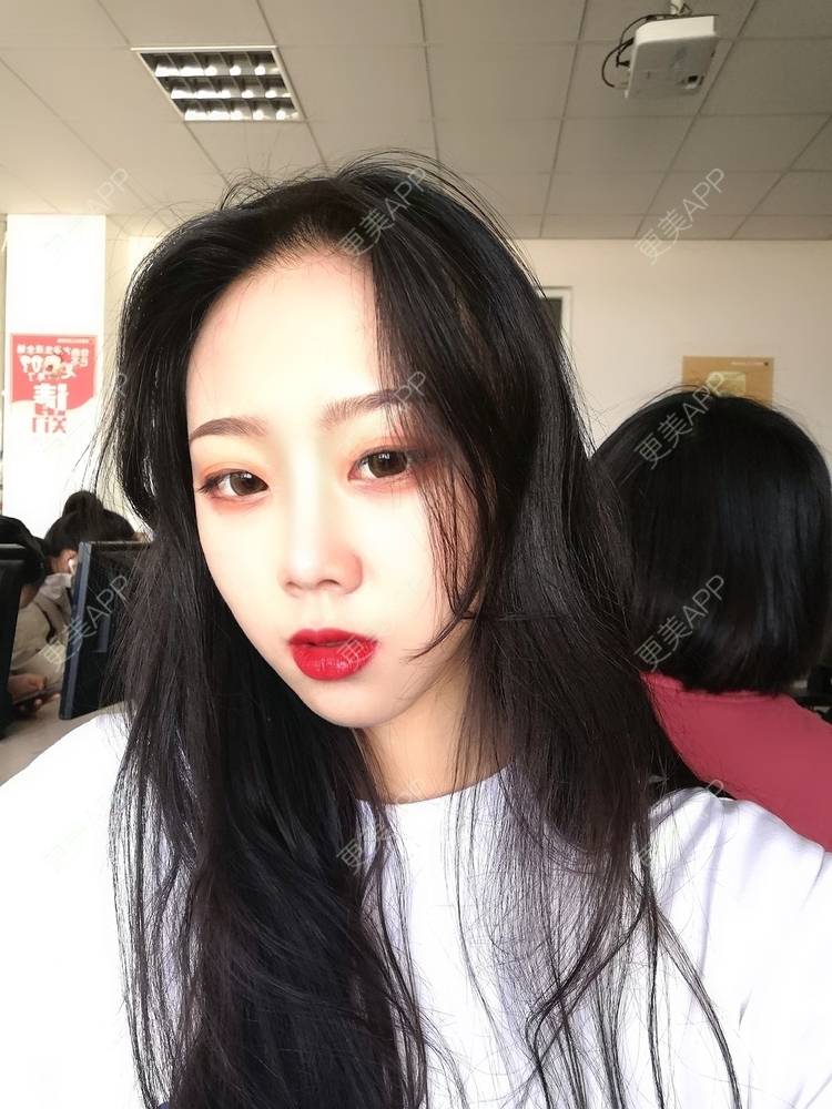 更美 - 更美用户vFETzv4uga的自体脂肪全面部填充经验 | 广州 | 自体脂肪全面部填充 | 视频日记