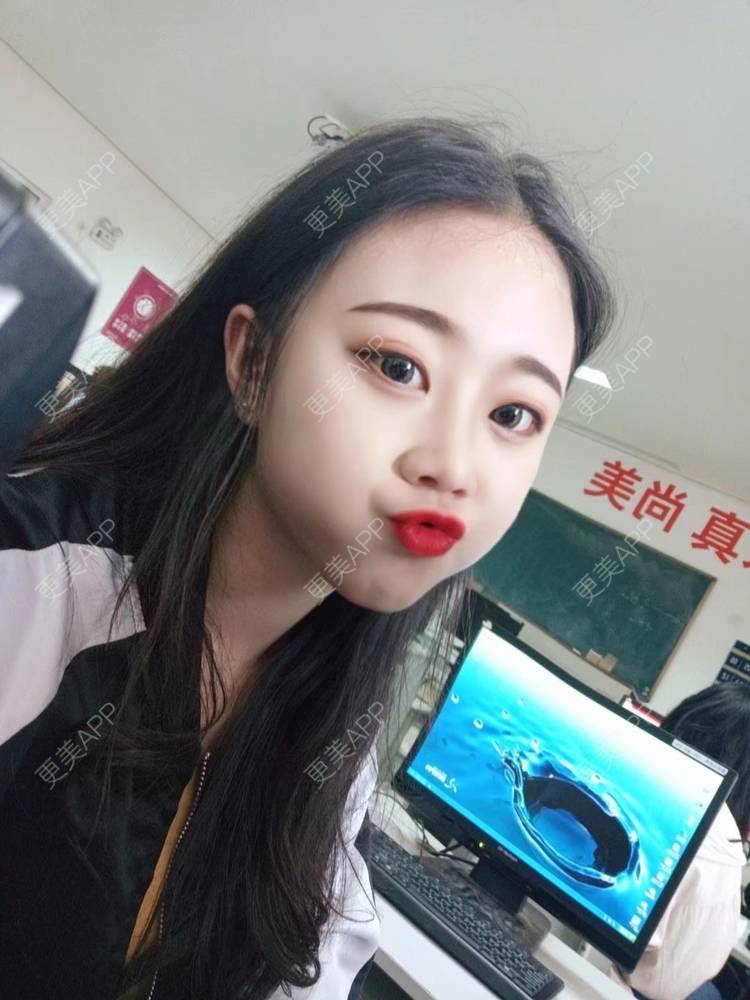 更美 - 更美用户vFETzv4uga的自体脂肪全面部填充经验 | 广州 | 自体脂肪全面部填充 | 视频日记