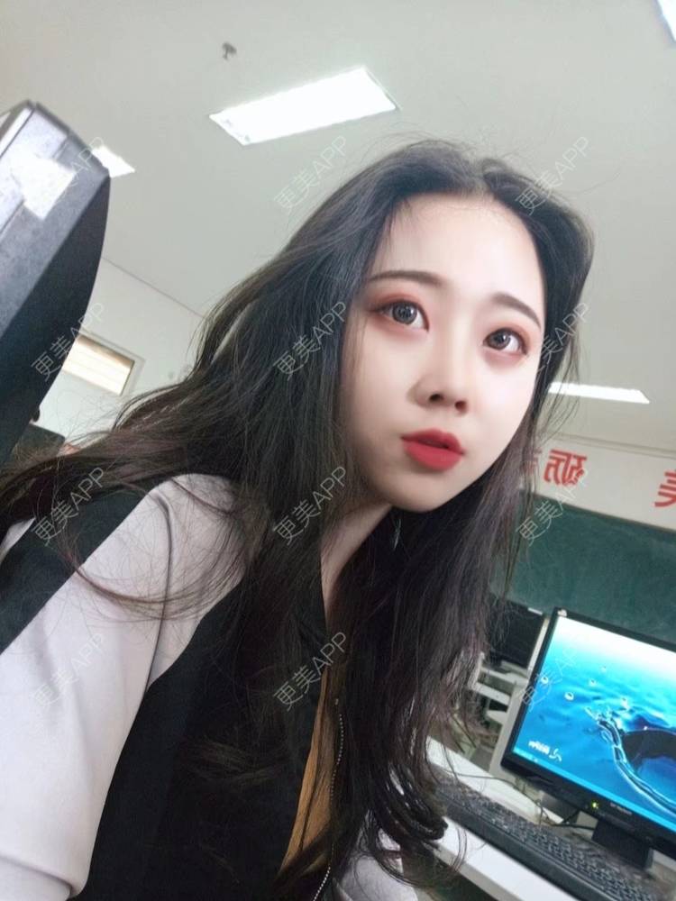 更美 - 更美用户vFETzv4uga的自体脂肪全面部填充经验 | 广州 | 自体脂肪全面部填充 | 视频日记