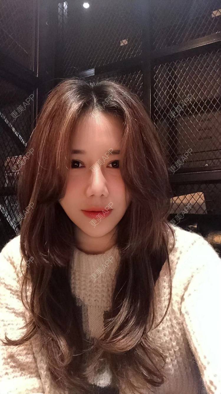 更美 - 娇滴滴的你的自体脂肪丰苹果肌经验 | 自体脂肪全面部填充 | 重庆 | 自体脂肪丰太阳穴 | 自体脂肪丰面颊 | 自体脂肪丰苹果肌 | 自体脂肪垫下巴