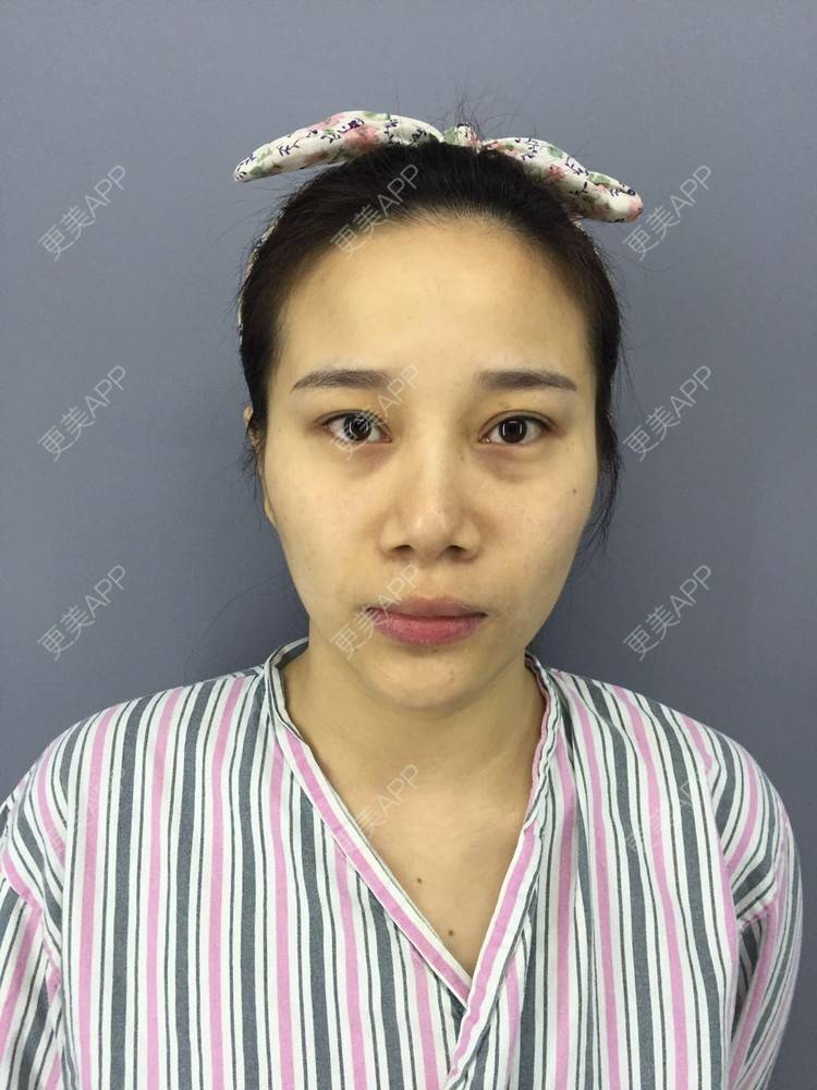 更美 - 娇滴滴的你的自体脂肪丰苹果肌经验 | 自体脂肪全面部填充 | 重庆 | 自体脂肪丰太阳穴 | 自体脂肪丰面颊 | 自体脂肪丰苹果肌 | 自体脂肪垫下巴