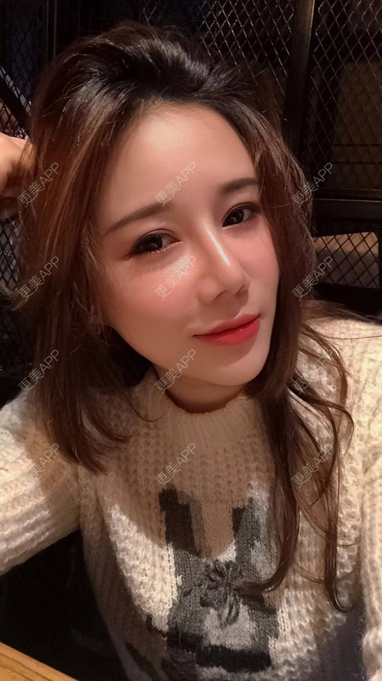 更美 - 娇滴滴的你的自体脂肪丰苹果肌经验 | 自体脂肪全面部填充 | 重庆 | 自体脂肪丰太阳穴 | 自体脂肪丰面颊 | 自体脂肪丰苹果肌 | 自体脂肪垫下巴