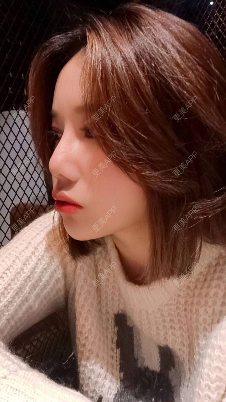 更美 - 娇滴滴的你的自体脂肪丰苹果肌经验 | 自体脂肪全面部填充 | 重庆 | 自体脂肪丰太阳穴 | 自体脂肪丰面颊 | 自体脂肪丰苹果肌 | 自体脂肪垫下巴