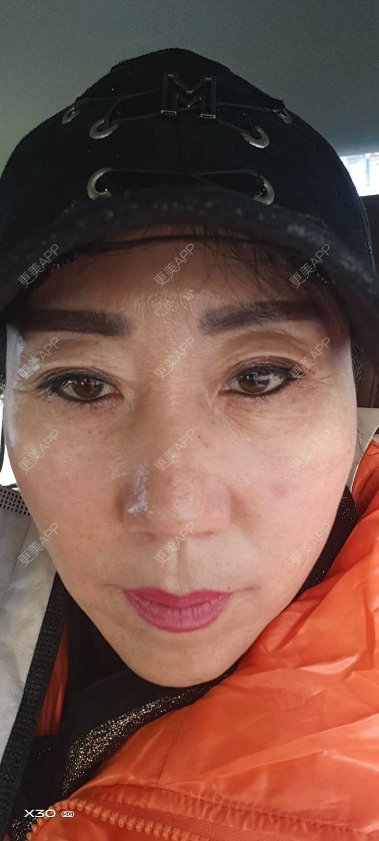 更美 - 我是一只小小鸟🐦的激光去眼袋经验 | 北京 | 激光去眼袋