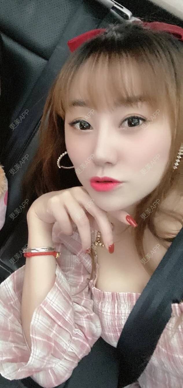 更美 - 画角声中仓的双眼皮经验 | 双眼皮修复 | 双眼皮 | 全切双眼皮 | 埋线双眼皮 | 定点双眼皮 | 南宁