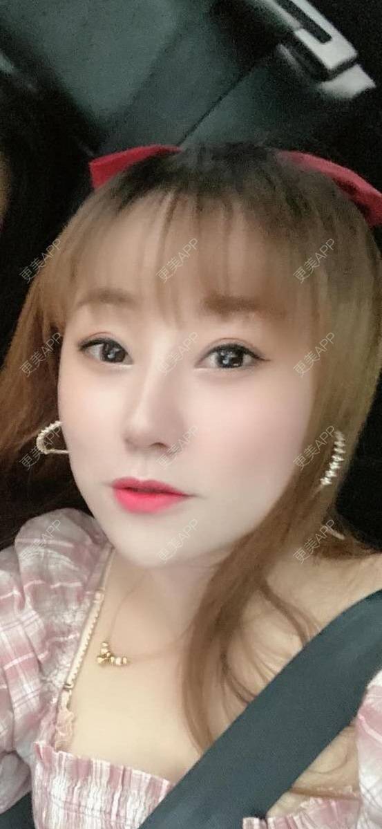 更美 - 画角声中仓的双眼皮经验 | 双眼皮修复 | 双眼皮 | 全切双眼皮 | 埋线双眼皮 | 定点双眼皮 | 南宁