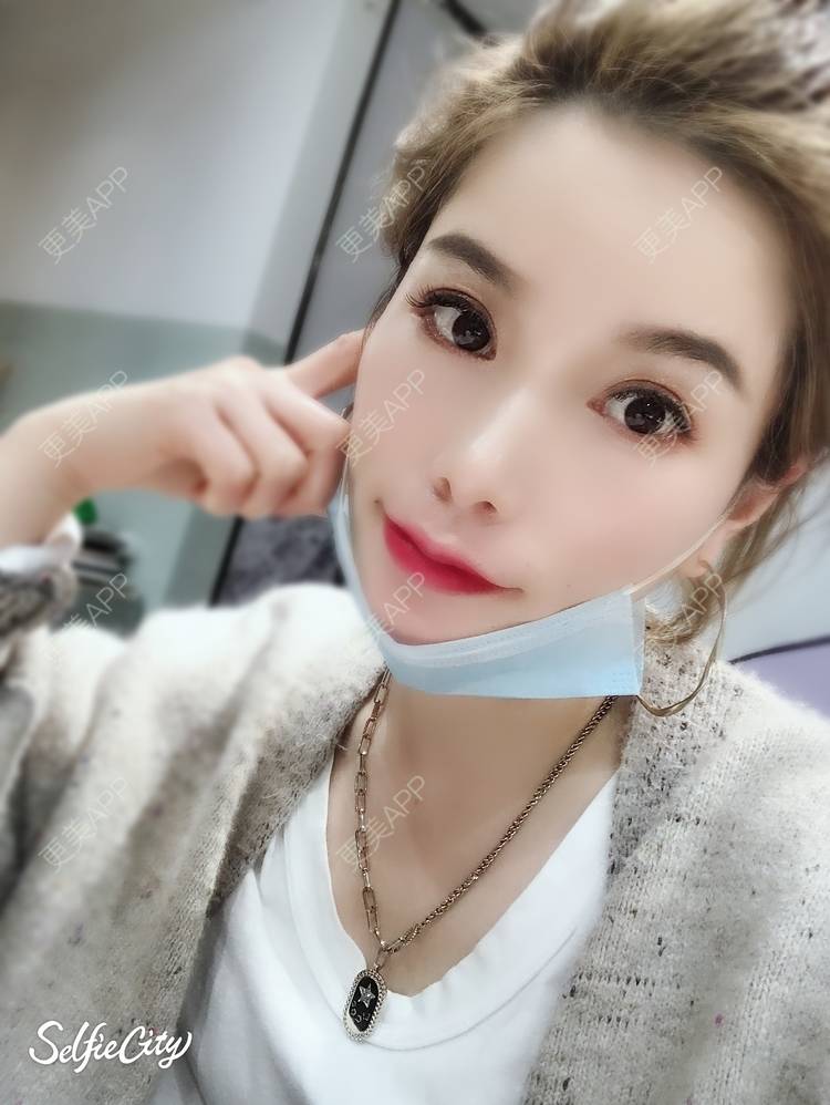 更美 - 小王兰儿的自体脂肪面部填充经验 | 自体脂肪面部填充 | 视频日记 | 泉州