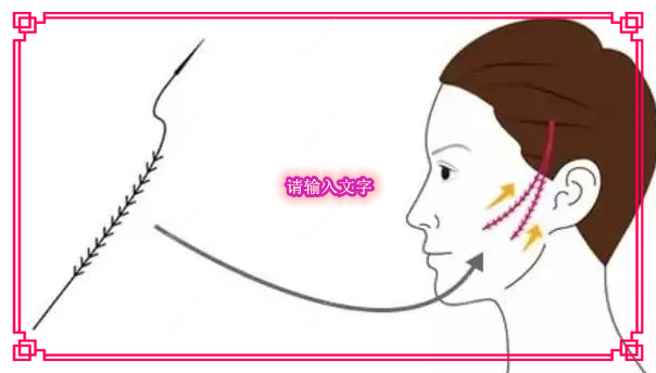 更美 - kris味苮女廖的埋线提升经验 | 北京 | 埋线提升