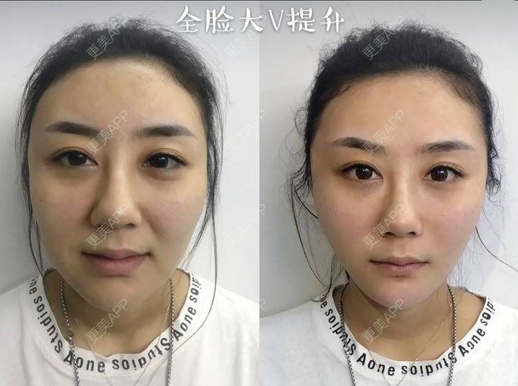 更美 - kris味苮女廖的埋线提升经验 | 北京 | 埋线提升