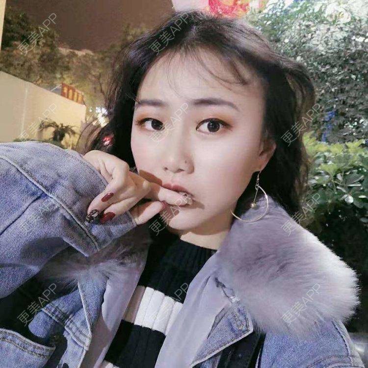 更美 - 小小的人儿欢乐多的自体脂肪面部填充经验 | 自体脂肪面部填充 | 视频日记 | 泉州